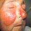 1. Erysipelas on Face Symptoms Pictures