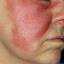 12. Erysipelas on Face Symptoms Pictures