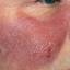 14. Erysipelas on Face Symptoms Pictures