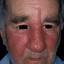 15. Erysipelas on Face Symptoms Pictures