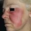 17. Erysipelas on Face Symptoms Pictures