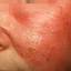 19. Erysipelas on Face Symptoms Pictures