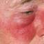 21. Erysipelas on Face Symptoms Pictures