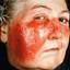 4. Erysipelas on Face Symptoms Pictures