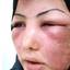 5. Erysipelas on Face Symptoms Pictures