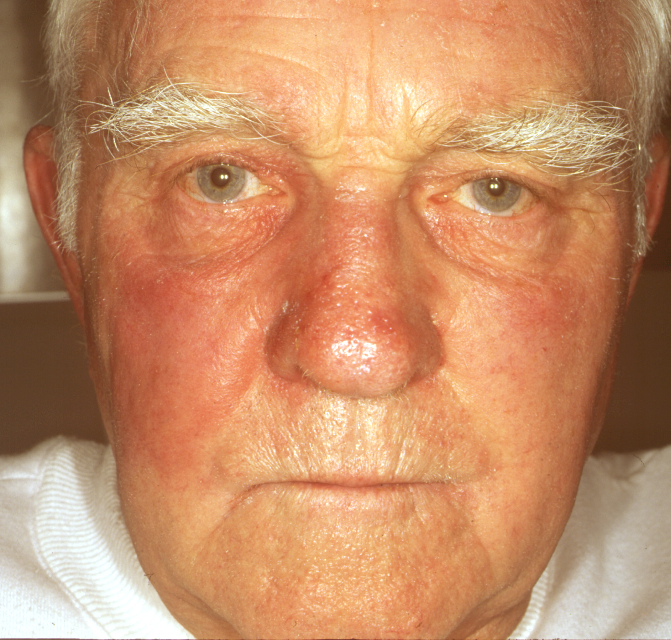 Красный нос у мужчины. Рожистое Erysipelas воспаление. Флегмонозное рожистое воспаление. Базалиома склеродермия. Рожистое воспаление эритематозно-буллёзная.