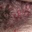 1. Folliculitis on Head Pictures