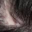 15. Folliculitis on Head Pictures