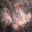 16. Folliculitis on Head Pictures