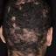 20. Folliculitis on Head Pictures