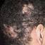 22. Folliculitis on Head Pictures