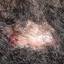 24. Folliculitis on Head Pictures