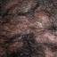25. Folliculitis on Head Pictures