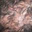 28. Folliculitis on Head Pictures