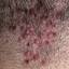 31. Folliculitis on Head Pictures