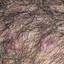 32. Folliculitis on Head Pictures