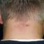 35. Folliculitis on Head Pictures
