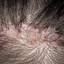 39. Folliculitis on Head Pictures