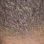 40. Folliculitis on Head Pictures