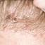 41. Folliculitis on Head Pictures