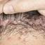42. Folliculitis on Head Pictures