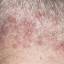 44. Folliculitis on Head Pictures