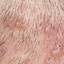 45. Folliculitis on Head Pictures