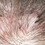 46. Folliculitis on Head Pictures