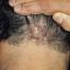 48. Folliculitis on Head Pictures