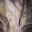 5. Folliculitis on Head Pictures