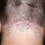 51. Folliculitis on Head Pictures