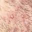 52. Folliculitis on Head Pictures