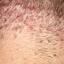 53. Folliculitis on Head Pictures