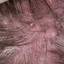 7. Folliculitis on Head Pictures