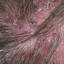8. Folliculitis on Head Pictures