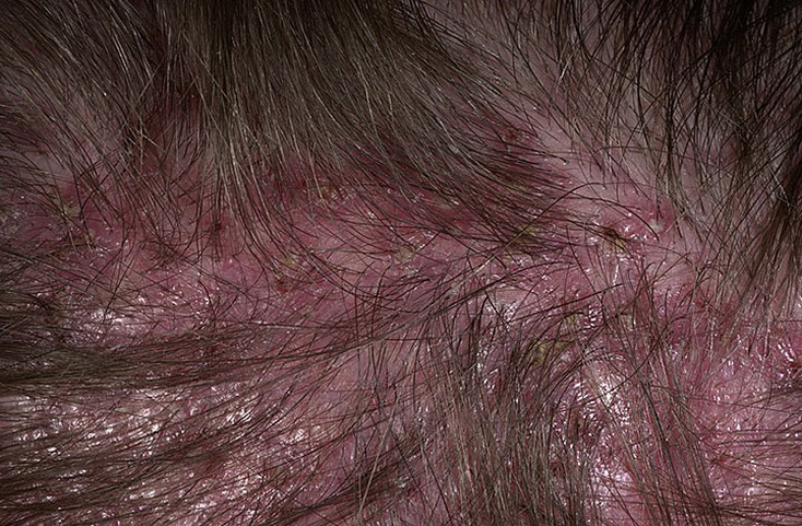 Folliculitis on Head Pictures – 54 Photos & Images / illnessee.com