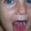 11. Scarlet Fever Symptoms in Children Pictures