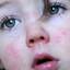 15. Scarlet Fever Symptoms in Children Pictures
