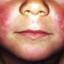 18. Scarlet Fever Symptoms in Children Pictures