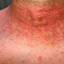 13. Scarlet Fever Symptoms in Adults Pictures