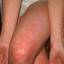 21. Scarlet Fever Symptoms in Adults Pictures