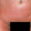 18. Scarlet Fever Rash in Adults Pictures