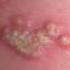 1. Symptoms of Herpes Pictures