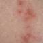 10. Symptoms of Herpes Pictures