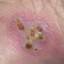 11. Symptoms of Herpes Pictures