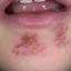 12. Symptoms of Herpes Pictures