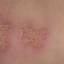 14. Symptoms of Herpes Pictures