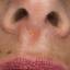 15. Symptoms of Herpes Pictures