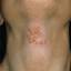 16. Symptoms of Herpes Pictures
