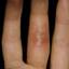 17. Symptoms of Herpes Pictures